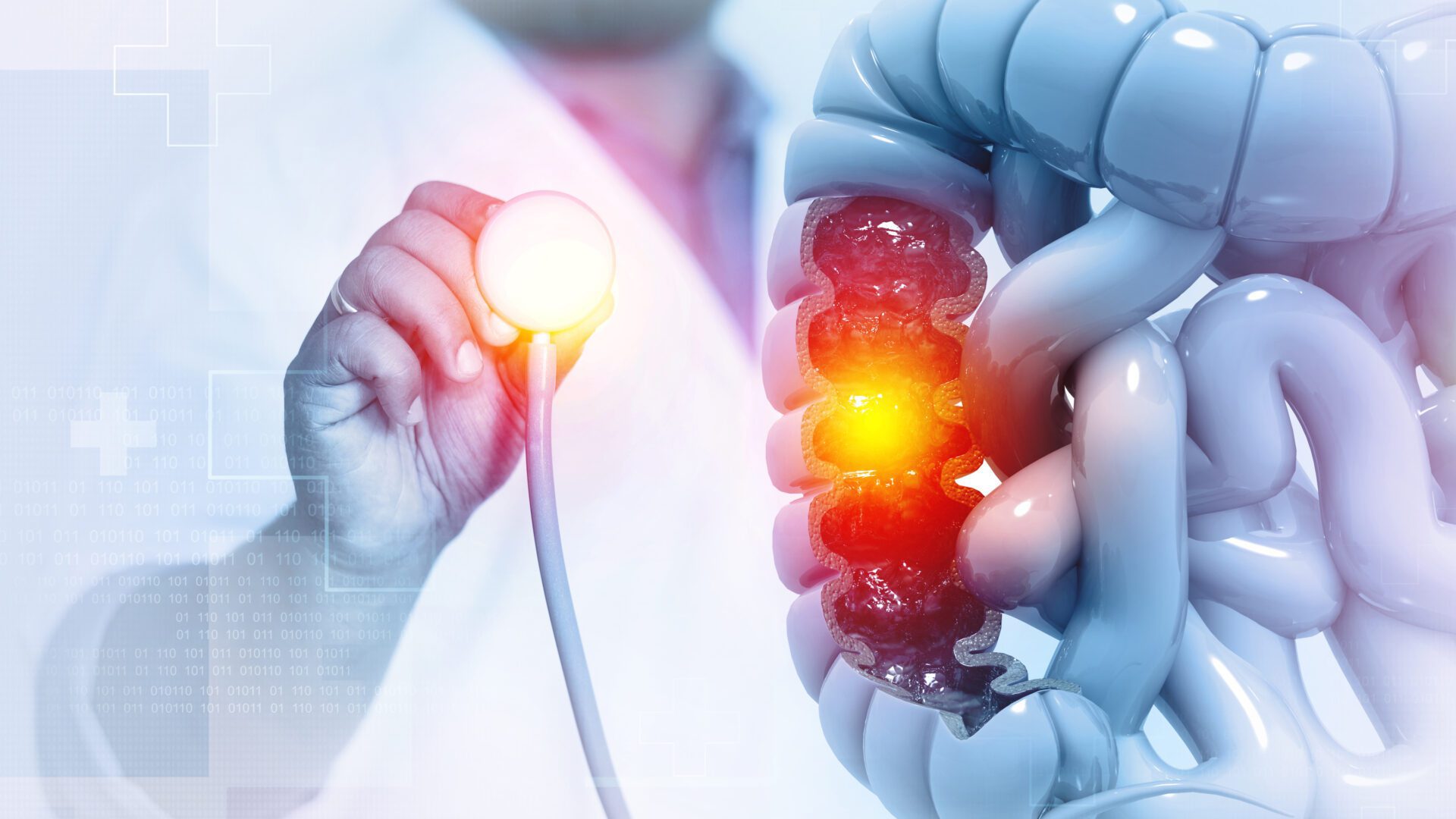 Le Suivi systématique postpolypectomie (SSPP) est un protocole innovant qui permet un suivi efficace et rapide des coloscopies