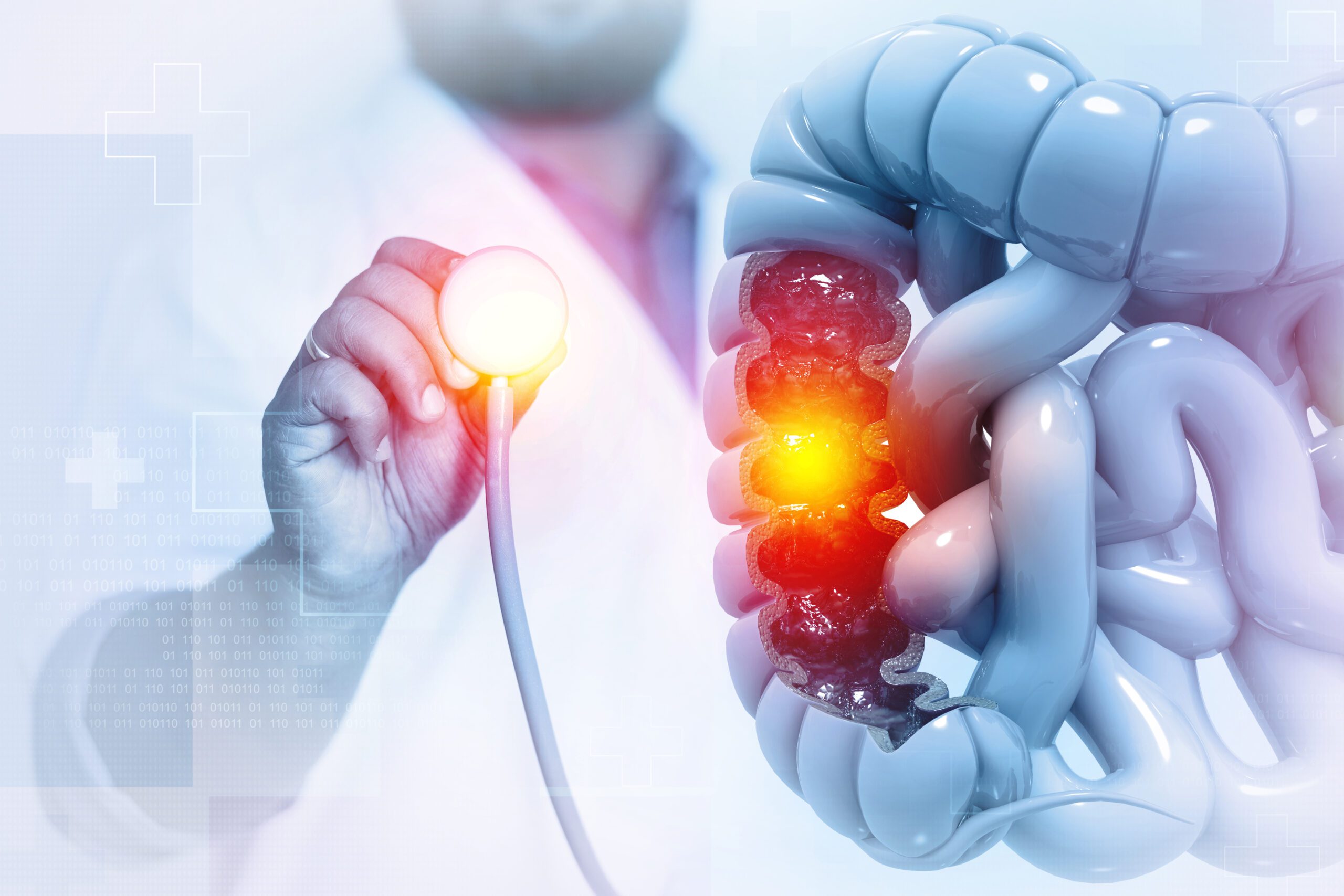 Le Suivi systématique postpolypectomie (SSPP) est un protocole innovant qui permet un suivi efficace et rapide des coloscopies